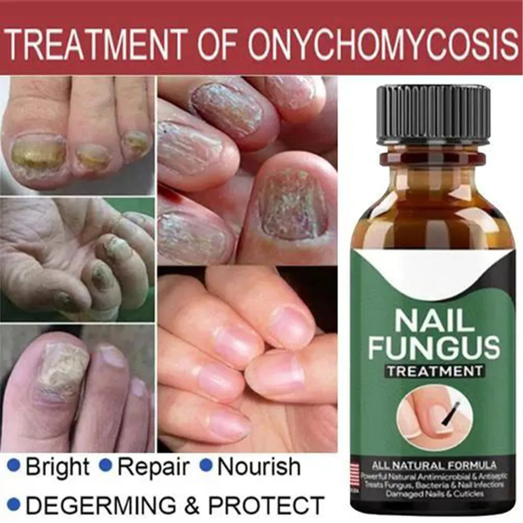 Ginger extract nail repair treatment for treating anti-fungal infections