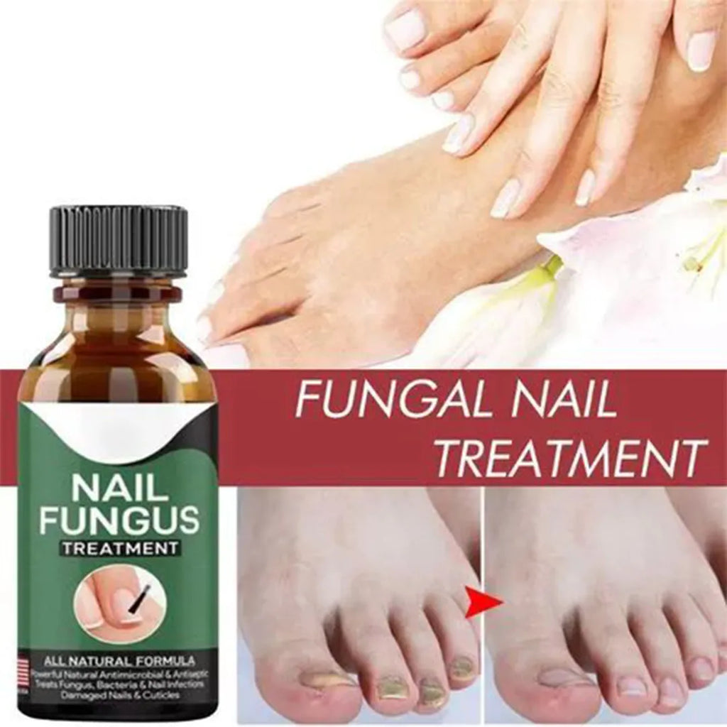 Solution to remove discolored layers with daily anti-fungal nail care