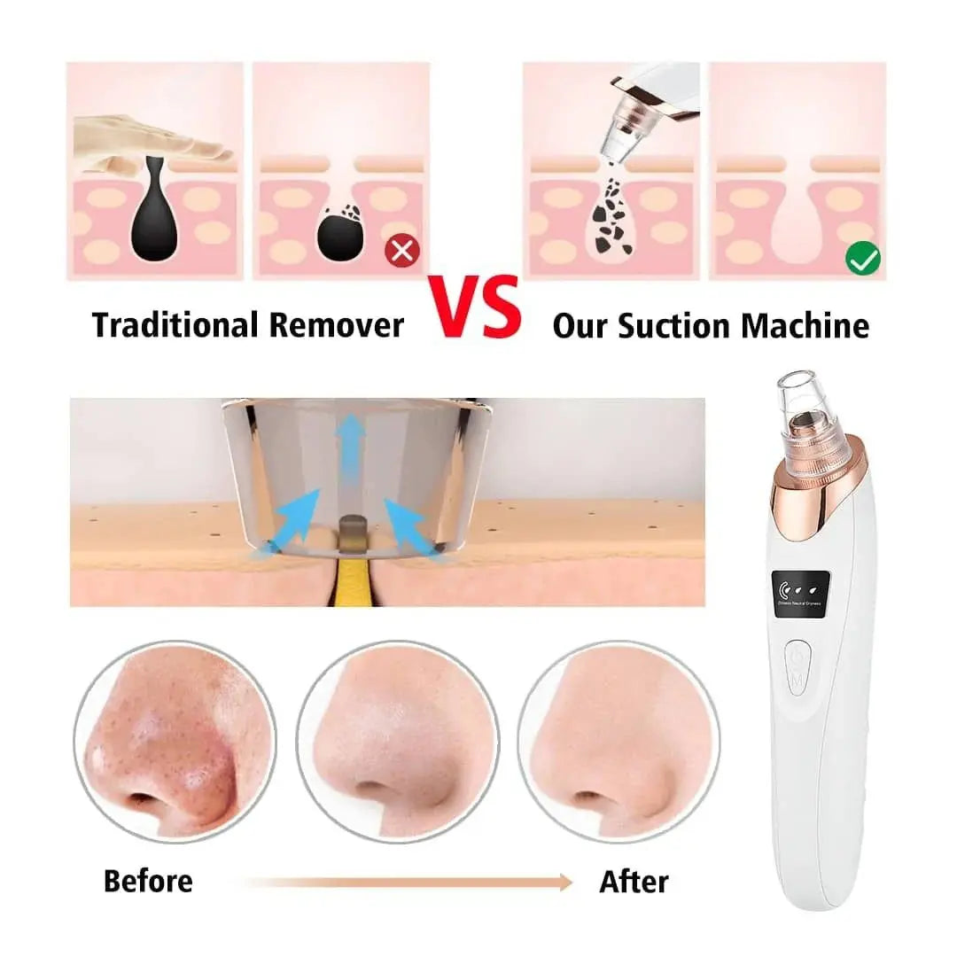 electric blackhead remover vacuum pore cleaner device